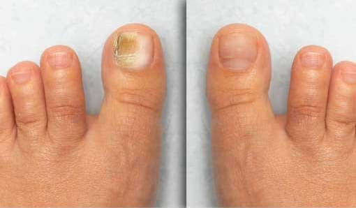 Depoimento visual de resultado com uso do ClearNail